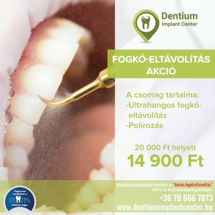 Fogkő Eltávolítás Akció Fogkő Eltávolítás Akció