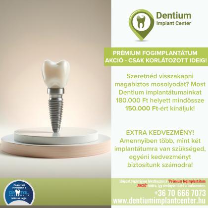 Prémium fogimplantátum AKCIÓ Prémium fogimplantátum AKCIÓ