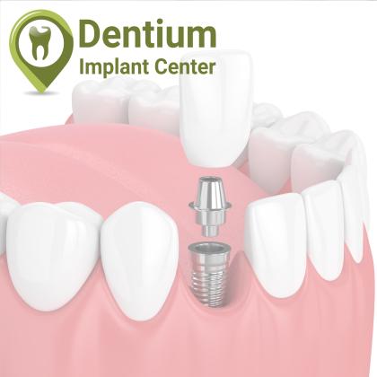 Implantológia - Éljen újra teljes életet! Implantológia - Éljen újra teljes életet!